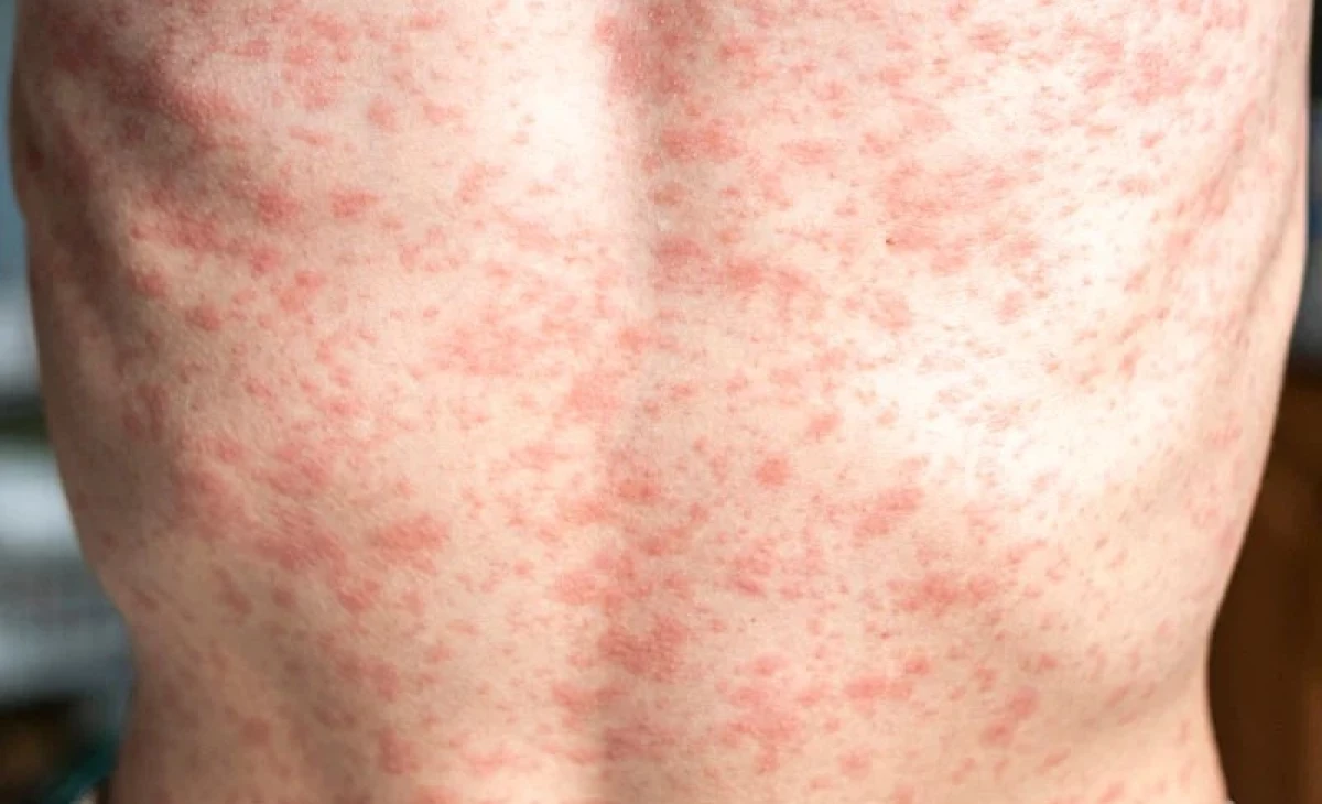HPA confirms two new measles cases in Greater Malé region