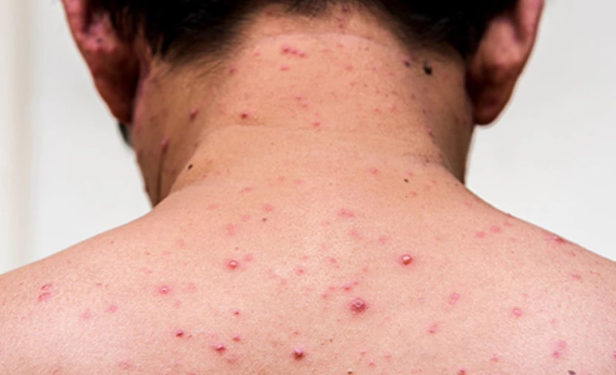 HPA launches public vaccination drive after new measles cases