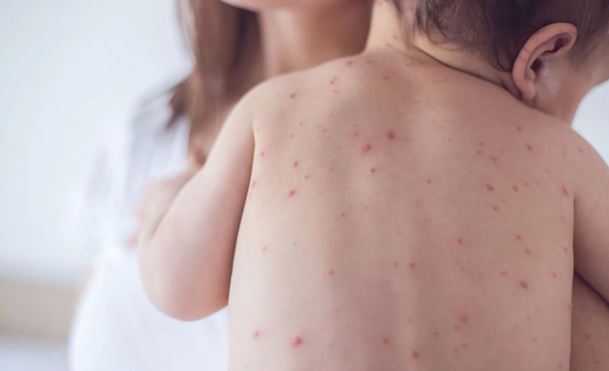 Maldives records 144 measles cases as weekly infections decline