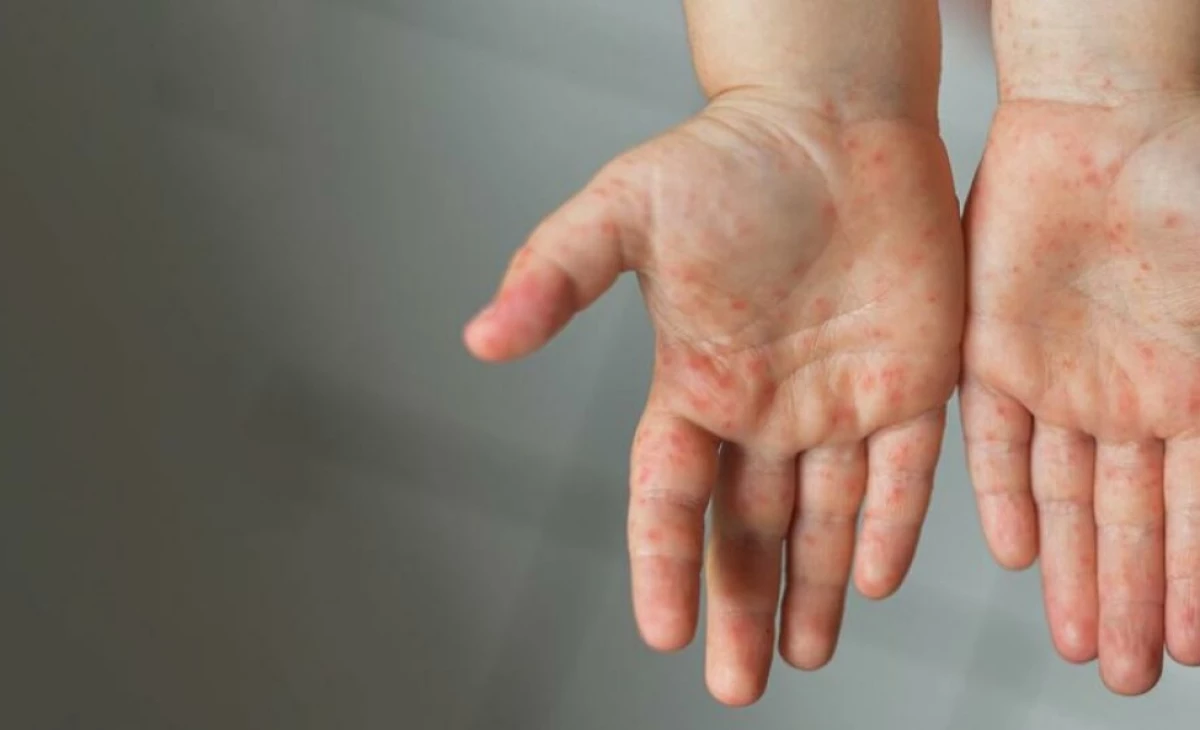 Measles cases rise to 199 in Maldives as 13 new cases reported